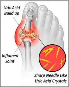 Symptoms Of Hyperuricemia You Should Watch Out For | Get Rid Of Gout