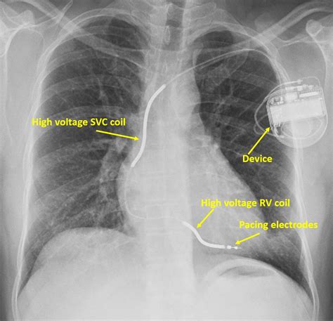 Chest X-ray showing implantable cardioverter defibrillator