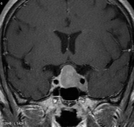 Pituitary macroadenoma | Radiology Reference Article | Radiopaedia.org