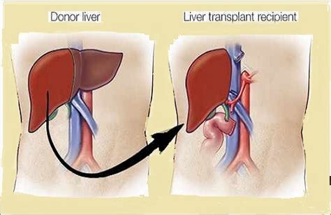 Quality of life after Liver Transplant surgery | Vaidam Health