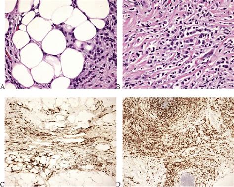 Pathology slides comparing omental and left axilla biopsy. (A) Omental... | Download Scientific ...