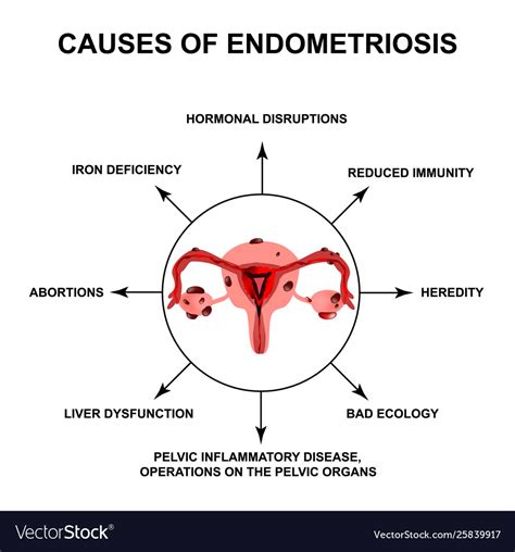 Causes endometriosis adenomyosis the Royalty Free Vector