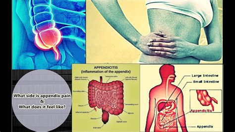 Appendix Pain - Location, Symptoms, Treatment, Causes - YouTube