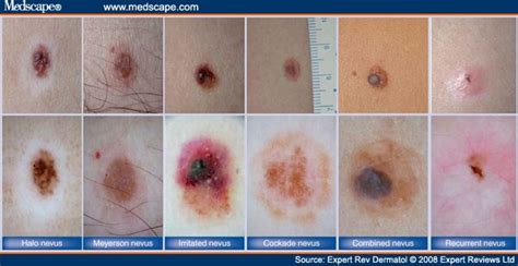 New Classification of Melanocytic Nevi Based on Dermoscopy