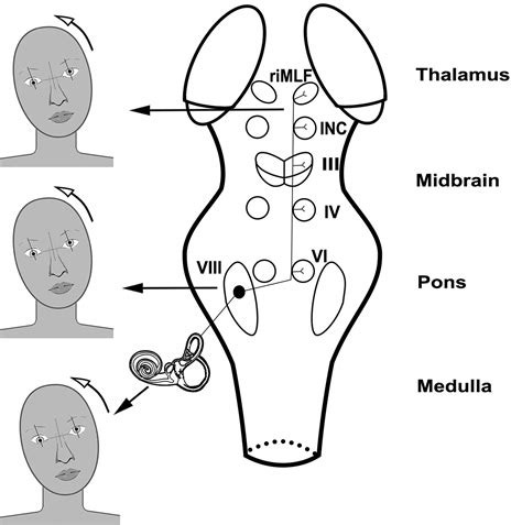 Ocular Tilt Reaction