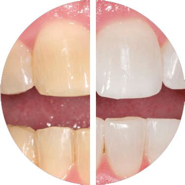 Opalescence PF Before After - Lansdowne, VA Family Dentistry