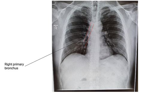 Diagnostic Accuracy of Right Bronchial Infiltration on Chest X-rays in Diagnosing COVID-19 ...