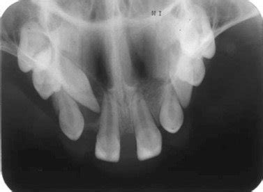 Occlusal X-ray of upper jaw showing placement of teeth present in the ...