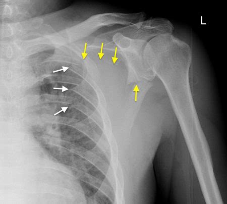 Scapular fracture - Radiology at St. Vincent's University Hospital