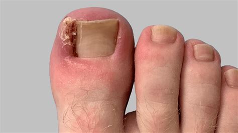 What to do for an ingrown toenail. - Dr. Nicholas Campitelli