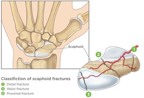 Scaphoid fracture causes, symptoms, diagnosis, treatment & revovery time