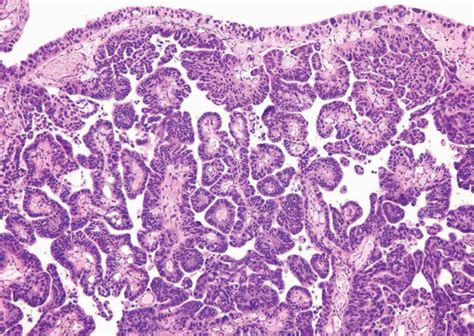 Histologic Variants of Urothelial Carcinoma | Abdominal Key