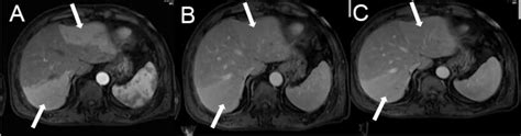 MRI manifestations of hepatic perfusion disorders