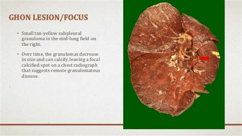 Radiographic manifestations of pulmonary tuberculosis