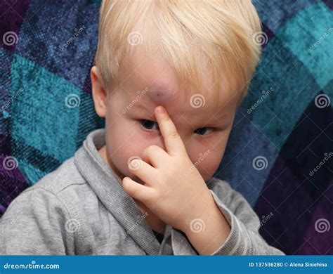 A Big Bruise on the Forehead of a Little Boy Stock Photo - Image of ...