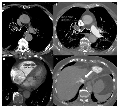 Tomography | Free Full-Text | Acute Pulmonary Embolism: Prognostic Role of Computed Tomography ...