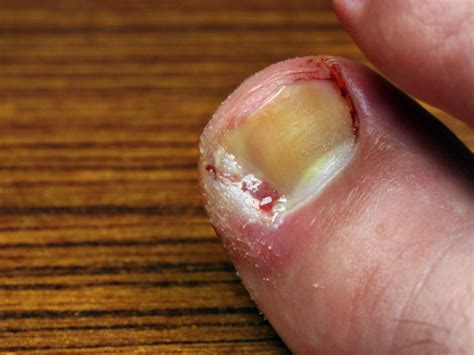 Ingrown Toenail Treatment at MD First Primary & Urgent Care