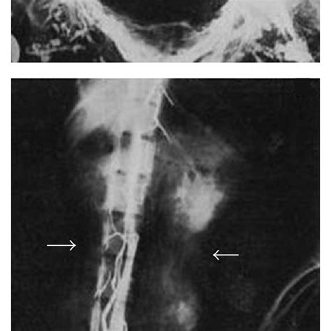 Batson venous plexus, from Batson O.V., “The function of the vertebral ...