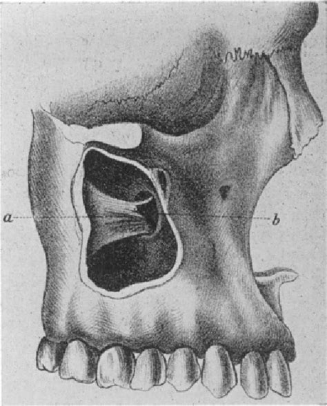 Figure 1 from XXII The Choanal Polyp | Semantic Scholar