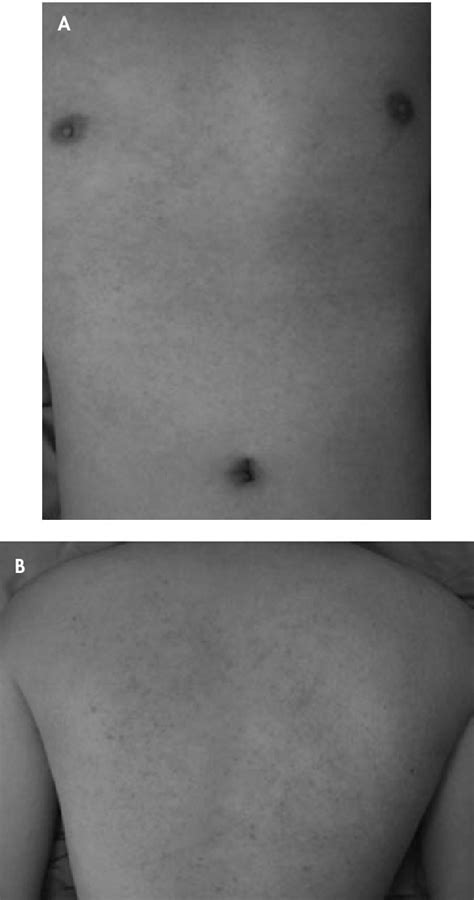 Skin Rash After Trazodone Use | Download Scientific Diagram