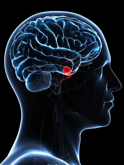 Brain Aneurysms: Symptoms, Causes, Diagnosis, and Treatment