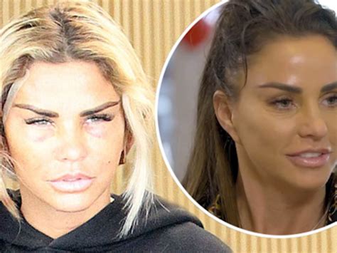 Katie Price Before And After