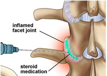 Facet Joint Injections – Northern Pain Centre