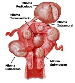 Miomatosis Uterina ¿es obligatoria la histerectomía? | Visión Salud