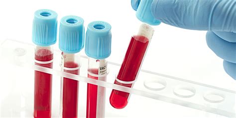 Blood Test That Allegedly Predicts Suicide Risk Only Looks Promising in the Media, Not in ...