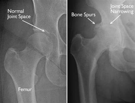 Understanding Hip Arthritis | Hofmann Arthritis Institute