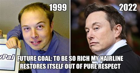 Elon Musk’s Hairline