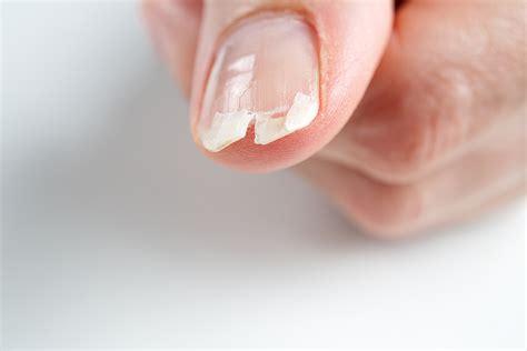 J'ai l'ongle fendu en longueur : causes et solutions - Le Mag Beauté