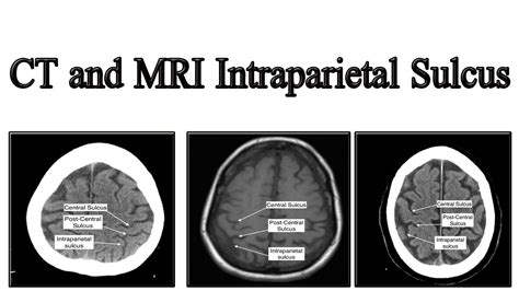 Intraparietal sulcus sing - YouTube