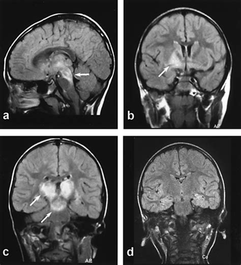 Encephalitis Lethargica - Cause, Symptoms, Diagnosis & Treatment