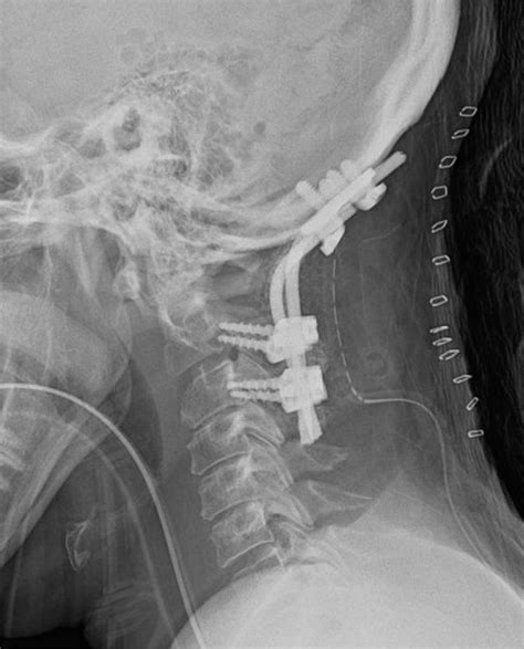 Instrumented reduction of a fixed C1–2 subluxation using occipital and ...