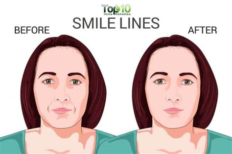 How to Prevent and Minimize Smile Lines | Top 10 Home Remedies