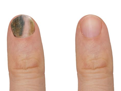 When to Get Dermatology Treatment for Your Nails | TN Telederm