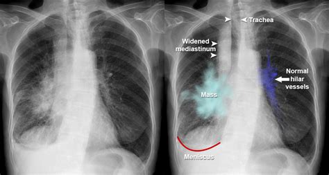 Lung Cancer Xray Vs Normal