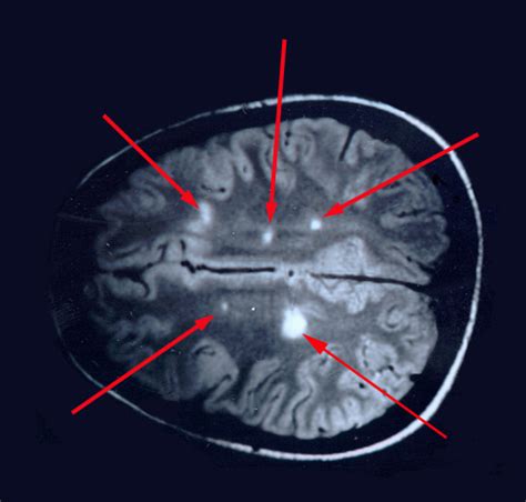 MRI Results