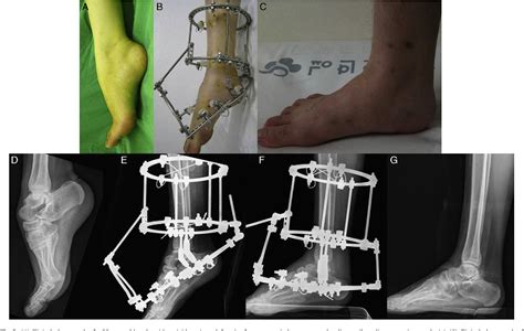 Figure 2 from Use of Ilizarov External Fixation Without Soft Tissue Release to Correct Severe ...