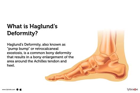 Haglund's Deformity: Causes, Symptoms, Treatment and Cost