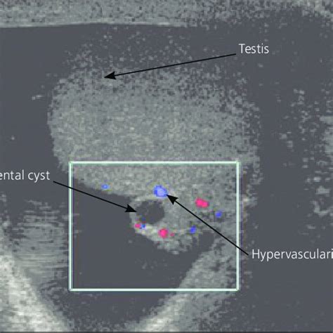 (PDF) Epididymitis and orchitis: An overview