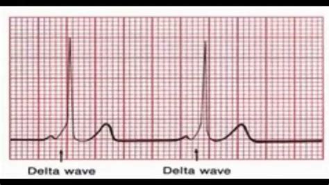 In your EKG, How to Identify Delta wave in WPW, What Is - YouTube