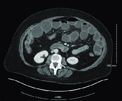 CT-enterography shows isolated Crohn's ileal stricture with persistent ...