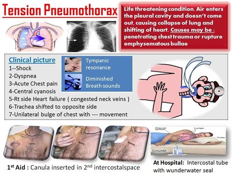 Tension pneumothorax: rapidly developing, life threatening. air leak causes increased pressure ...