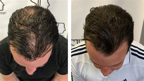 Hair Thinning Solution - Scalp Micropigmentation for Men and Women ...