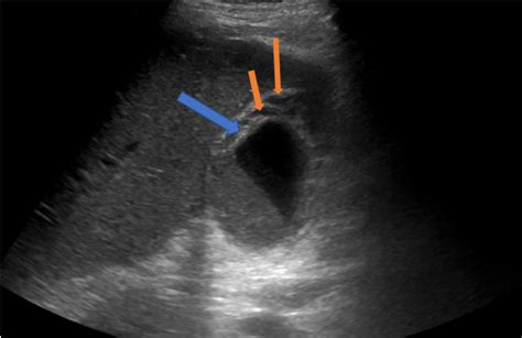 Cureus | Occult-Perforated Gangrenous Gallbladder Found on Magnetic Resonance ...