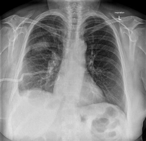 Loculated Pleural Effusion : Loculated Pleural Effusion Chest X Ray ...