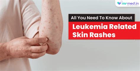 All you need to know about: Cancer skin rash and leukemia - MrMed