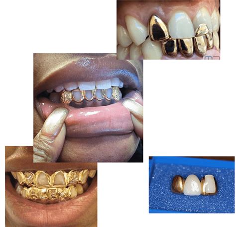 Platinum Gold Teeth